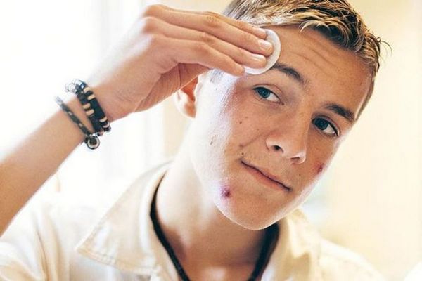 How to Avoid Teen Acne and Prevent Adult Acne in Future?